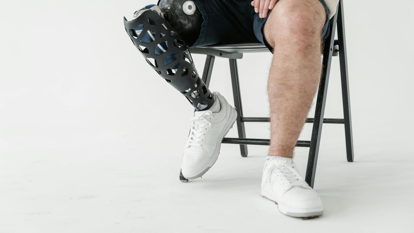 Why did Peeta get his leg amputated?