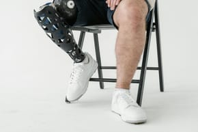 Why Did Peeta Get His Leg Amputated?